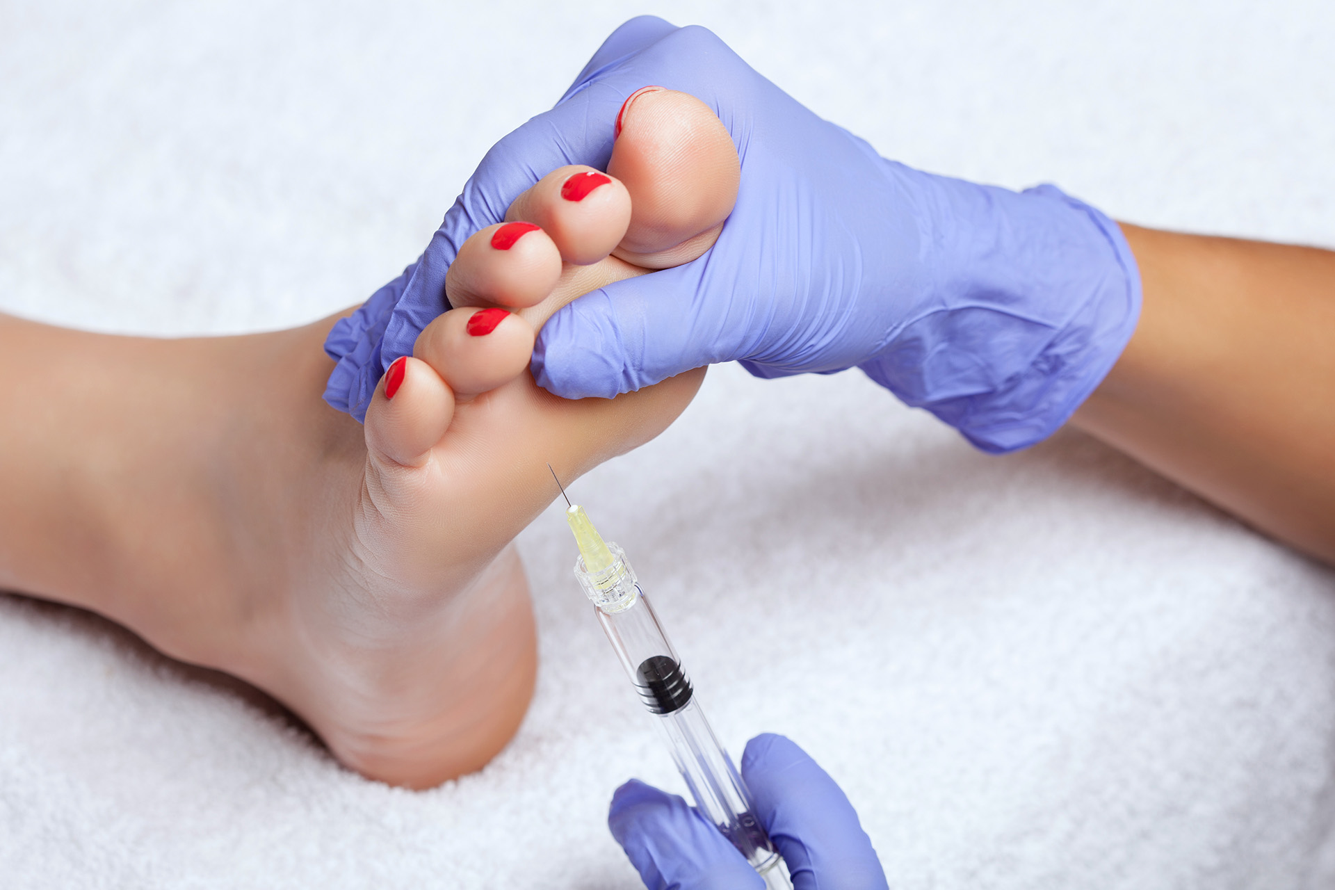 Taub Podiatry | Infection of the Foot   Ankle, Warts and Corns   Calluses
